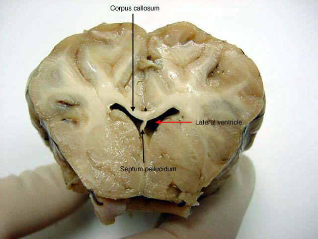 coronal brain labeled